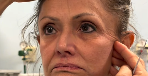 Você já ouviu falar do deep plane facelift? destaque